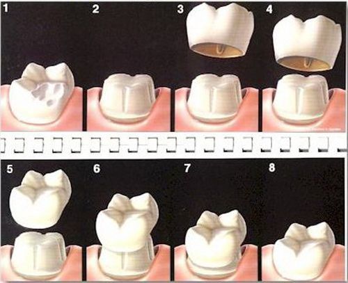Bọc răng sứ như thế nào ? Bọc răng sứ như thế nào ?