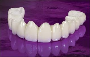 Răng sứ Cercon HT – Giải pháp cho vẻ đẹp hoàn thiện