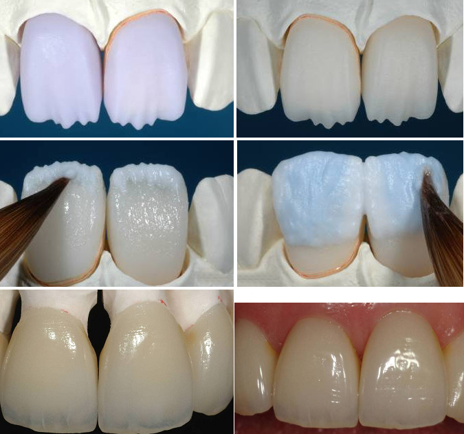 răng sứ cercon và những điều cần biết răng sứ cercon và những điều cần biết