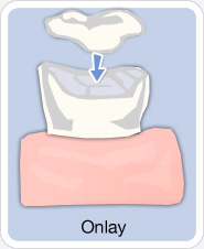 Trám Onlay lại bao phủ lên toàn bộ bề mặt của răng covered_onlay