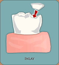 Inlay là một miếng trám được đúc để phục hồi hình dáng của răng inlay
