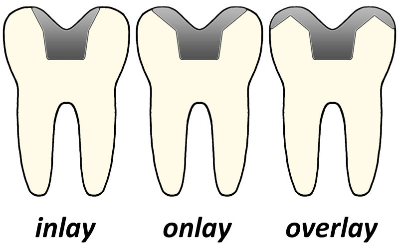 Inlay và Onlay phục hồi tốt nhất cho răng mất chất từ nhẹ đến trung bình inlay_onlay_overlay