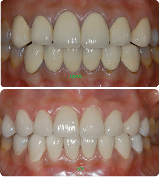 răng sứ cercon và những điều cần biết răng sứ cercon và những điều cần biết
