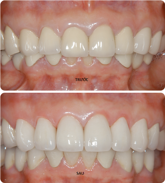 răng sứ cercon và những điều cần biết răng sứ cercon và những điều cần biết
