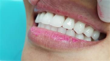 Thẩm mỹ bằng sứ Cercon là như thế nào