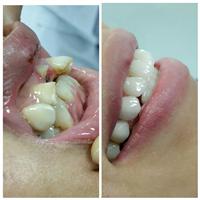 Sự khác nhau giữa răng sứ cercon và zirconia