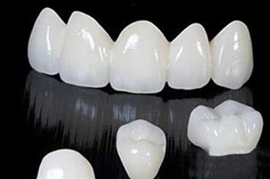 RĂNG SỨ TOÀN SỨ CERCON - NỤ CƯỜI RẠNG NGỜI